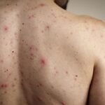 Argentina confirma nuevo caso importado de sarampión y activa alerta epidemiológica